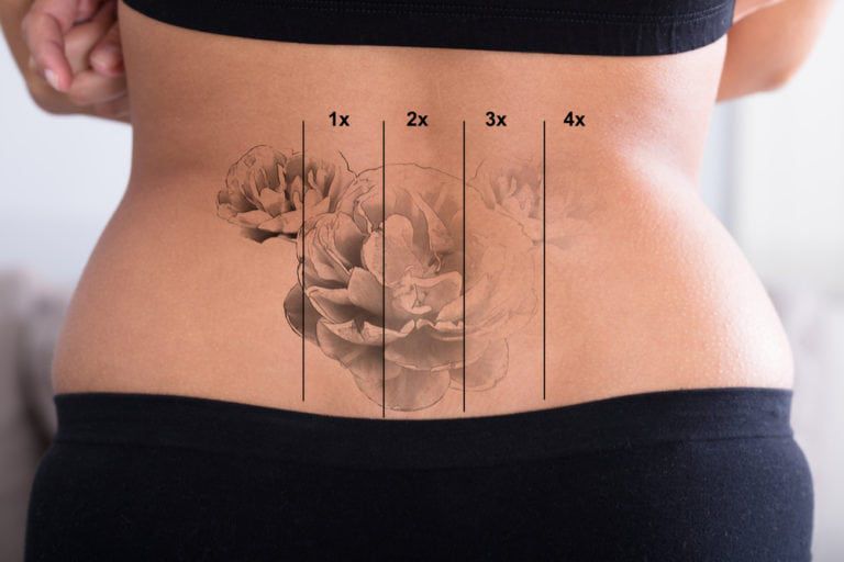 Îndepărtare tatuaje prin excizie chirurgicală a tatuajului