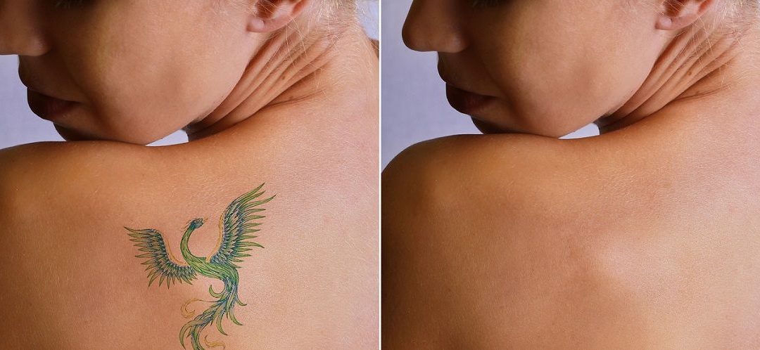 Indepartarea tatuaje - stergere tatuaj