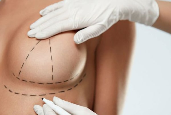 Mamopexie - Ridicarea sânilor cu proteze
